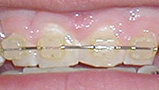 white brackets