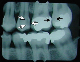 second cavity